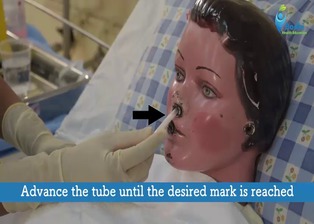 Naso Gastric (NG) Tube Insertion, Removal and Feeding